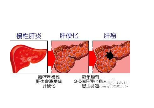 中草药良方治愈肝病-间医师杨雄树