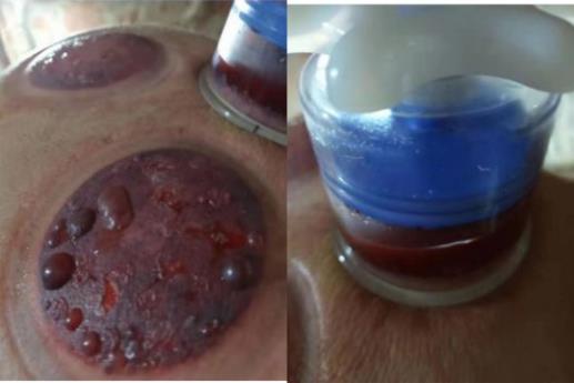 岐黄之道、吸透为本  ——黎阳、张德凤