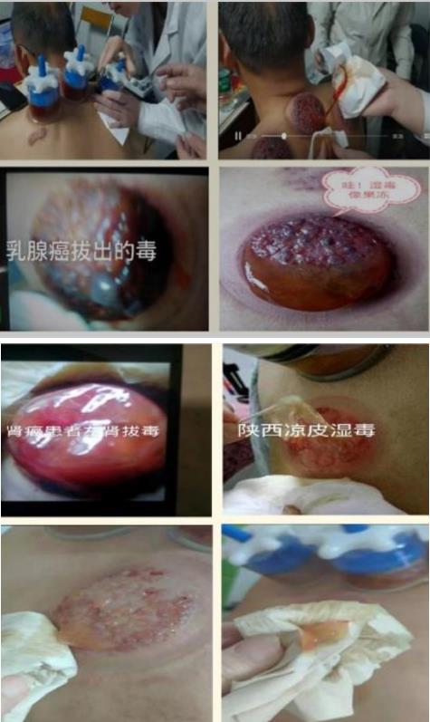 岐黄之道、吸透为本  ——黎阳、张德凤