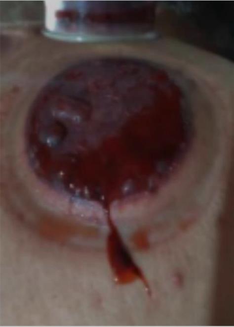 岐黄之道、吸透为本  ——黎阳、张德凤