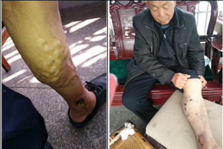 中医国粹人物——治疗急慢性肾小球肾炎、慢性肾功能衰竭等疾病 连正福医师