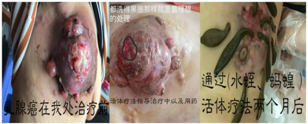 中医国粹人物专题报道---中医肿瘤专家周崇立七代祖传中医