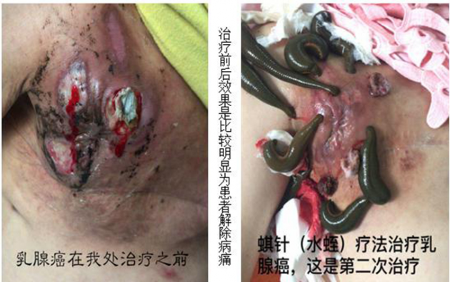 中医国粹人物专题报道---中医肿瘤专家周崇立七代祖传中医