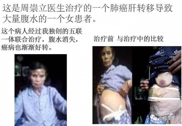 中医国粹人物专题报道---中医肿瘤专家周崇立七代祖传中医