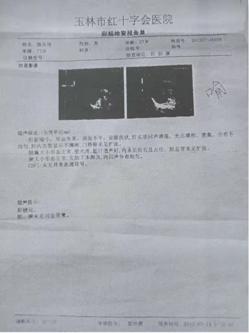 治疗肝硬化 肝腹水签订医患合同——专家邱延存