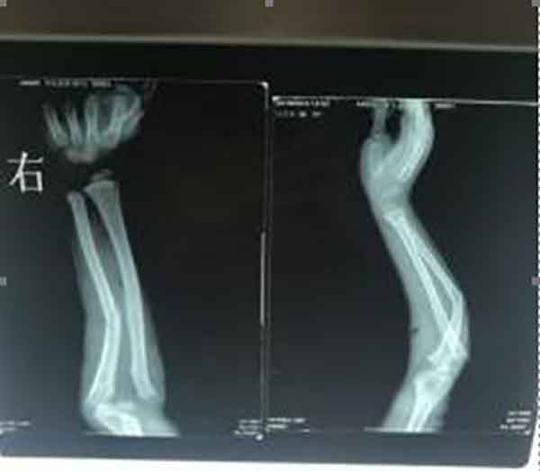 仁心铸新法,徒手愈顽疾 记中医正骨专家——曾令先