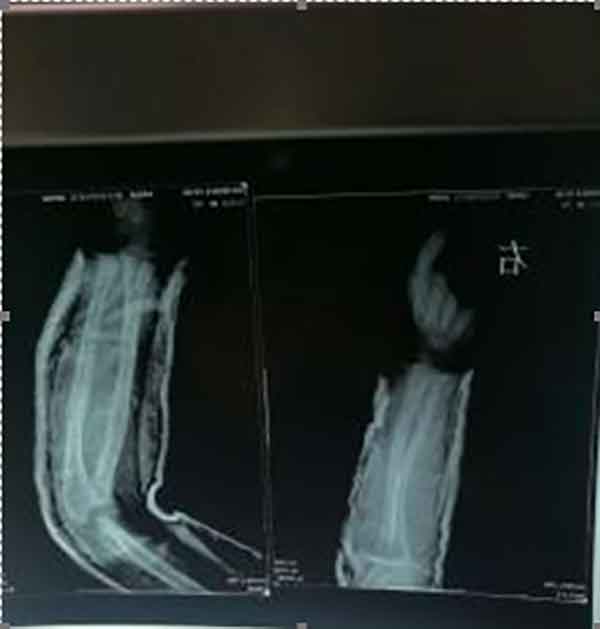 仁心铸新法,徒手愈顽疾 记中医正骨专家——曾令先