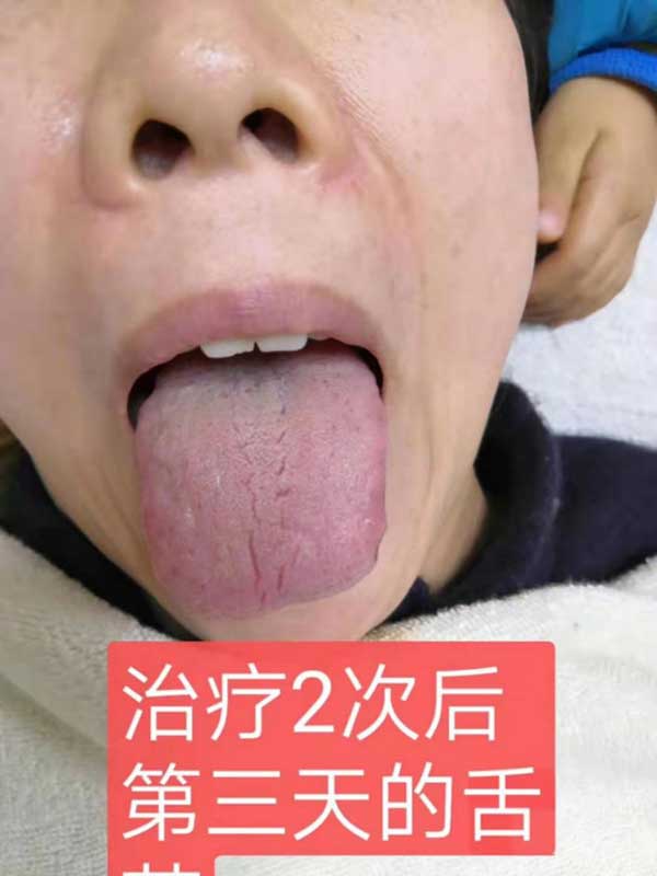 当代针刀医学传承人 — 孟德林