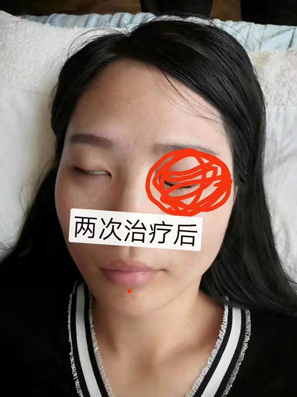 当代针刀医学传承人 — 孟德林