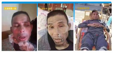 记当代中医骨膜消结术创始人——潘杏富