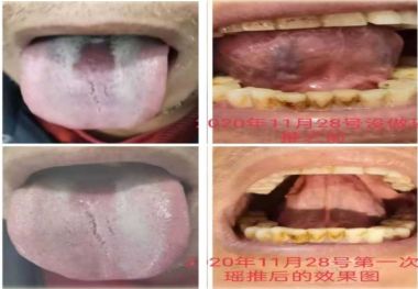 著名瑶医银疗推拿专家——周继辉