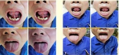 著名瑶医银疗推拿专家——周继辉