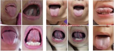 著名瑶医银疗推拿专家——周继辉