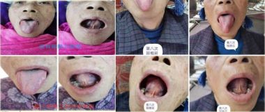 著名瑶医银疗推拿专家——周继辉