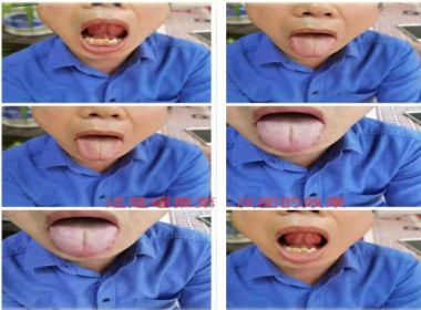 著名瑶医银疗推拿专家——周继辉